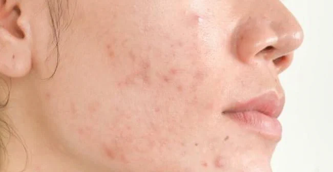 Sau khi nặn mụn kiêng ăn gì để da nhanh lành và không để lại sẹo